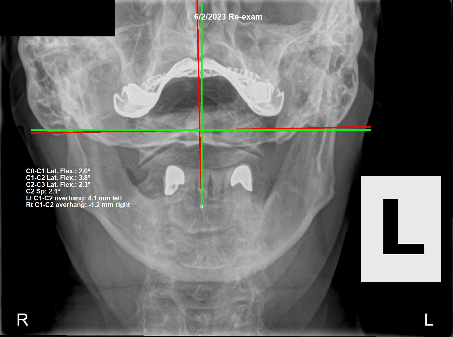 June 2, 2023 re-evaluation AP cervical X-ray showing significant correction of C1 alignment, Rochet Family Chiropractic Royal Palm Beach