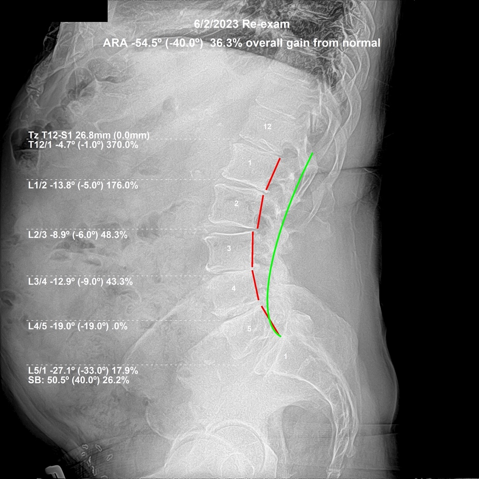 June 2, 2023 re-evaluation lateral lumbar X-ray showing improved angulation and alignment between L3 and L5, Rochet Family Chiropractic Royal Palm Beach