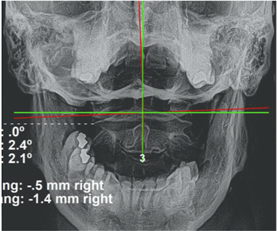 Initial AP upper cervical X-ray — upper cervical subluxation before corrective care, Rochet Family Chiropractic Royal Palm Beach