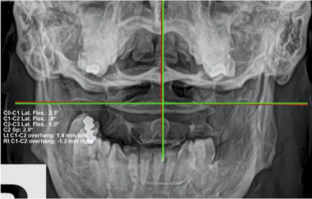 Re-evaluation AP upper cervical X-ray — improved upper cervical alignment after 6-month correction program, Rochet Family Chiropractic Royal Palm Beach
