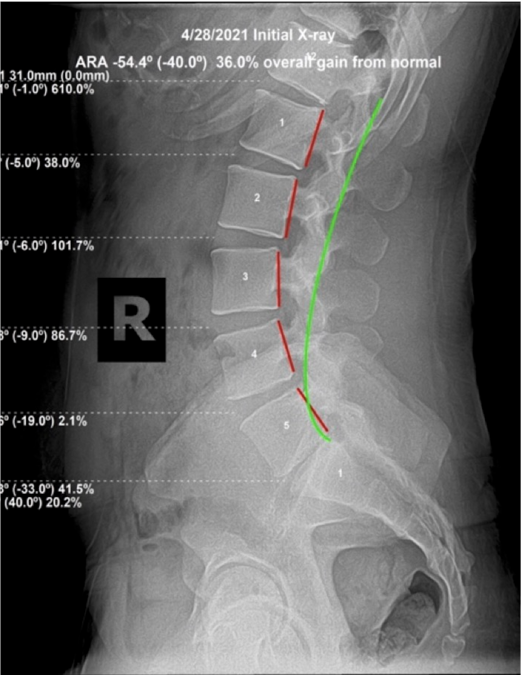 April 28, 2021 initial lateral lumbar X-ray showing ARA -64.6 degrees against -40.0 normal, 36.8 percent overall loss from normal in 37-year-old international bodybuilder with L5 disc herniation, Rochet Family Chiropractic Royal Palm Beach