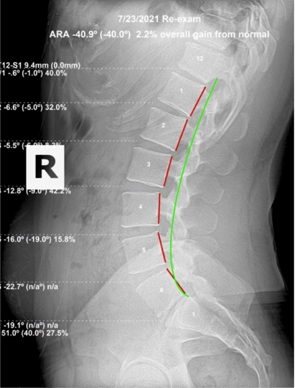 July 21, 2021 re-evaluation lateral lumbar X-ray showing ARA -40.0 degrees with 2.3 percent gain from normal after three months of corrective chiropractic care, Rochet Family Chiropractic Royal Palm Beach