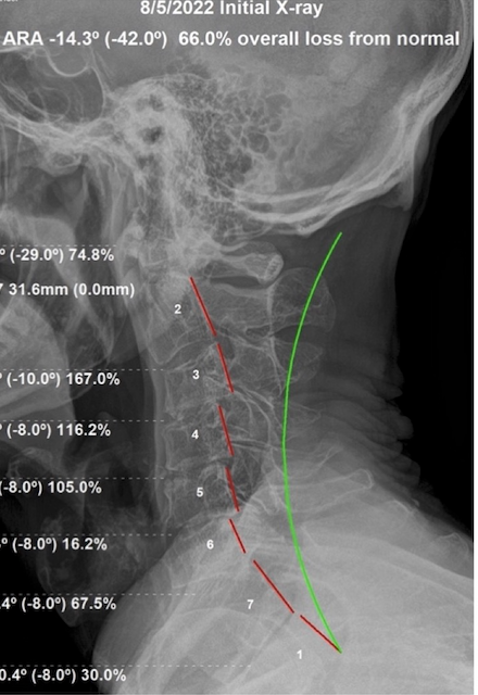 Initial lateral cervical X-ray of a 78-year-old male showing over 60 percent loss of normal cervical alignment with disc degeneration, Rochet Family Chiropractic Royal Palm Beach