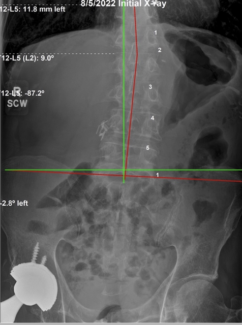 Initial AP lumbar and pelvic X-ray of a 78-year-old male showing severe low back subluxation and postural imbalance from a leg-length difference, Rochet Family Chiropractic Royal Palm Beach