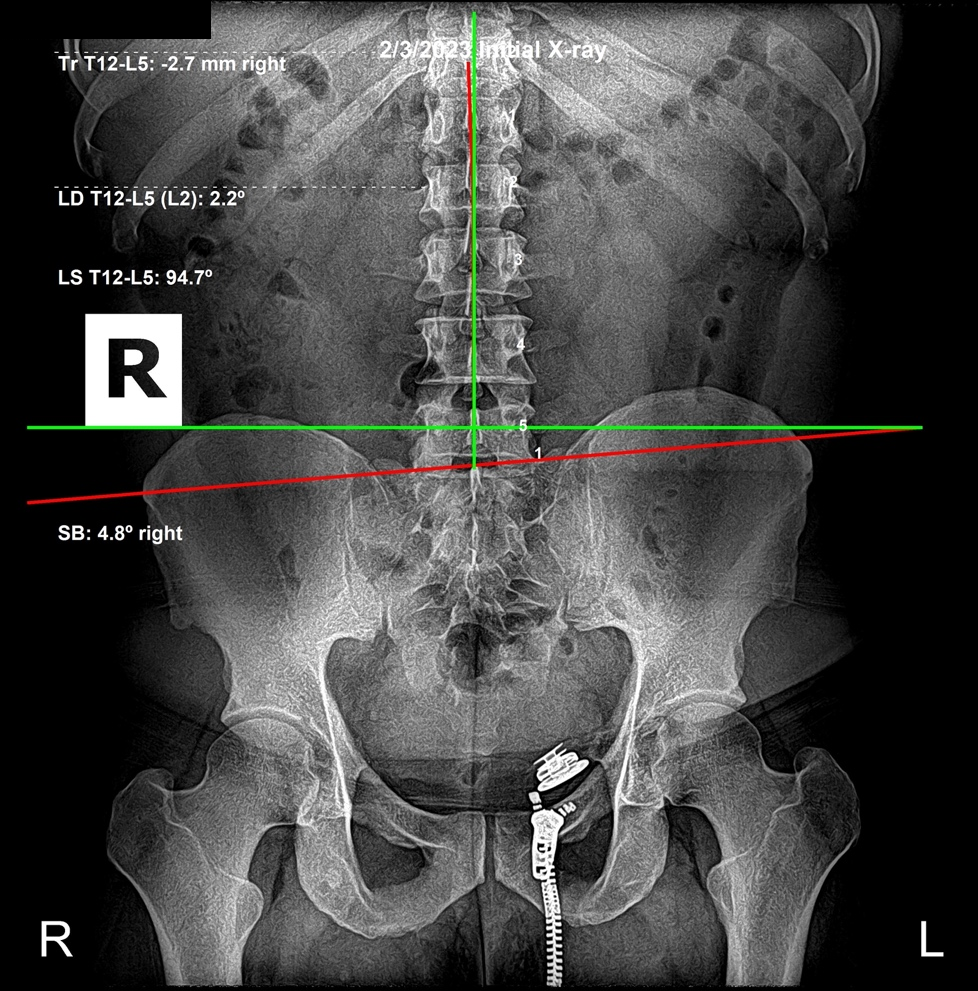 Initial AP lumbar X-ray showing an AI sacrum subluxation on the right in a 33-year-old male tech worker, Rochet Family Chiropractic Royal Palm Beach