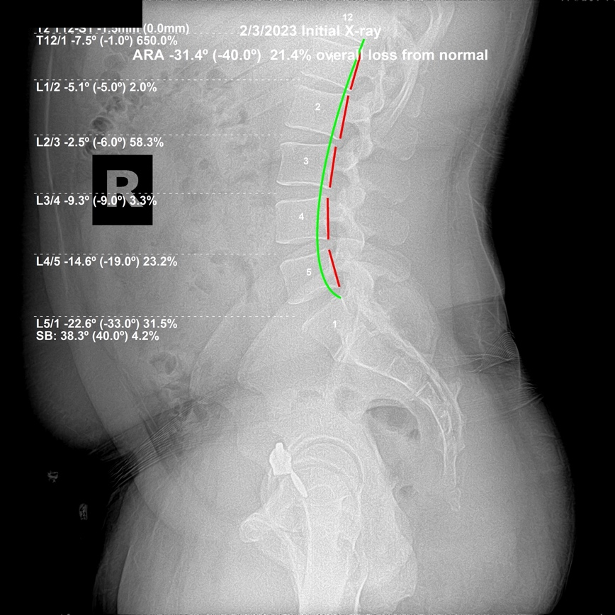 Initial lateral lumbar X-ray showing the lumbar spine compensating by straightening with ligament laxity at L2 L3 and L3 L4, Rochet Family Chiropractic Royal Palm Beach
