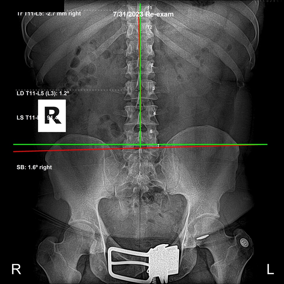 Re-evaluation AP lumbar X-ray showing the sacral subluxation reduced and lumbar alignment near textbook ideal, Rochet Family Chiropractic Royal Palm Beach
