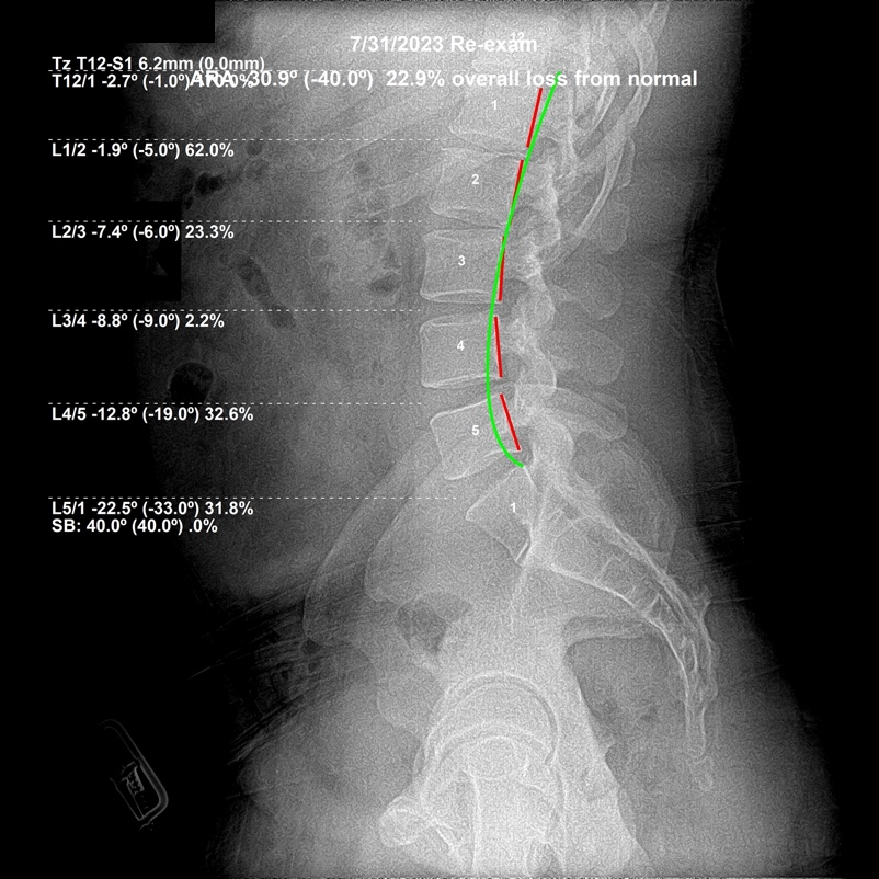 Re-evaluation lateral lumbar X-ray showing restored lumbar alignment after subluxation-based corrective care, Rochet Family Chiropractic Royal Palm Beach