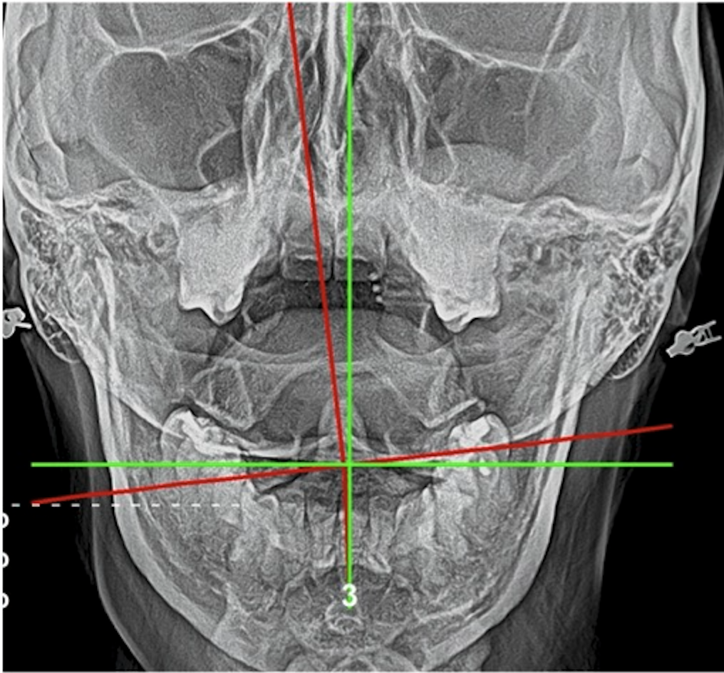 Initial AP upper cervical X-ray showing severe atlas subluxation — significant lateral misalignment of C1 creating brainstem and spinal cord pressure, Rochet Family Chiropractic Royal Palm Beach