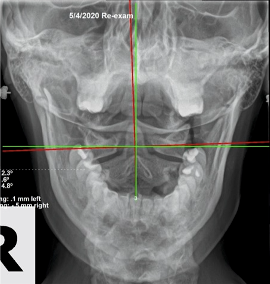 May 4, 2020 re-exam AP upper cervical X-ray showing improved atlas position after 6-month correction program, Rochet Family Chiropractic Royal Palm Beach