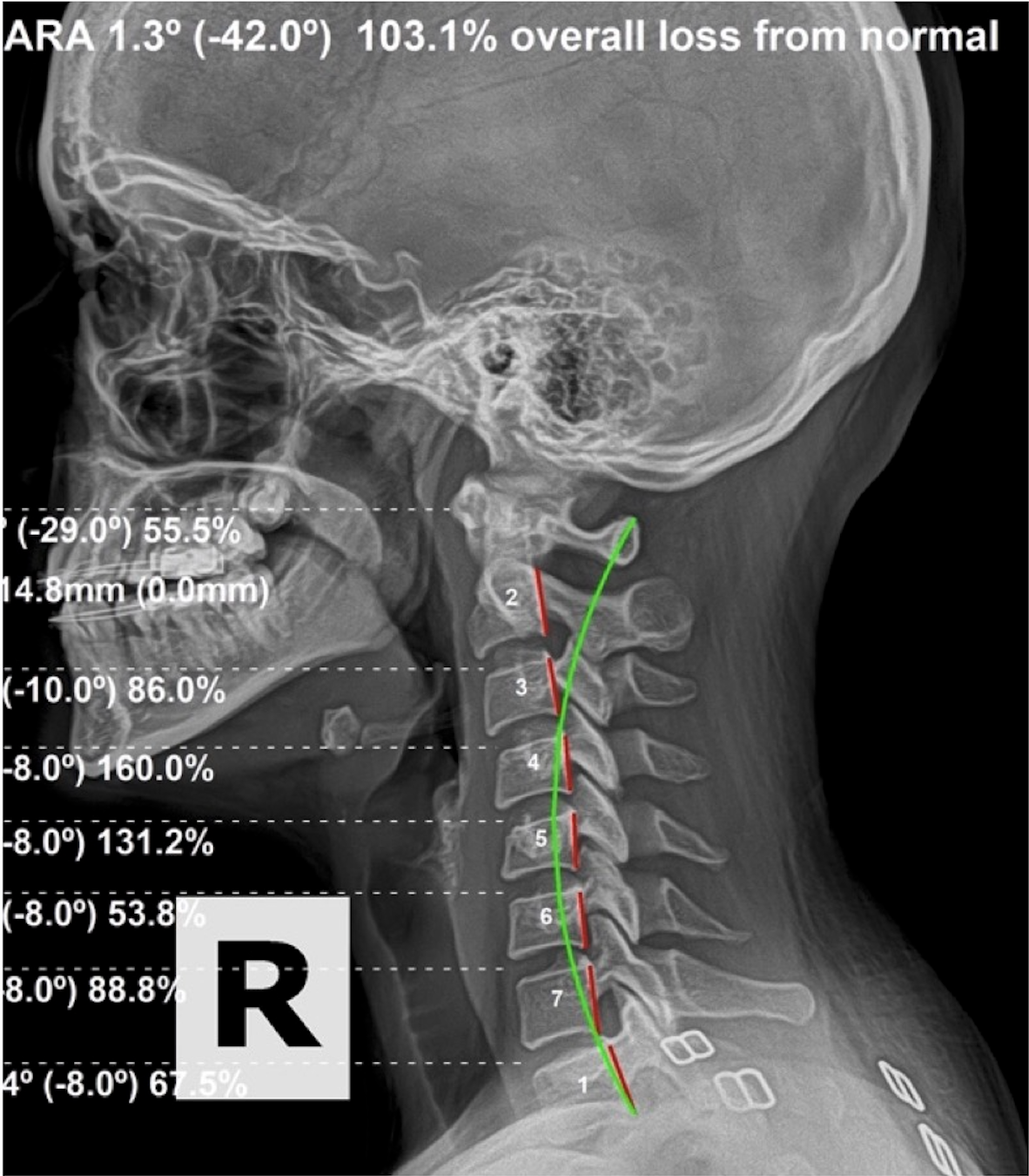 Initial lateral cervical X-ray showing ARA 1.3 degrees against -42.0 normal, 103.1 percent overall loss from normal in 34-year-old female with screen-time cervical subluxation, migraines, and hand paresthesia, Rochet Family Chiropractic Royal Palm Beach