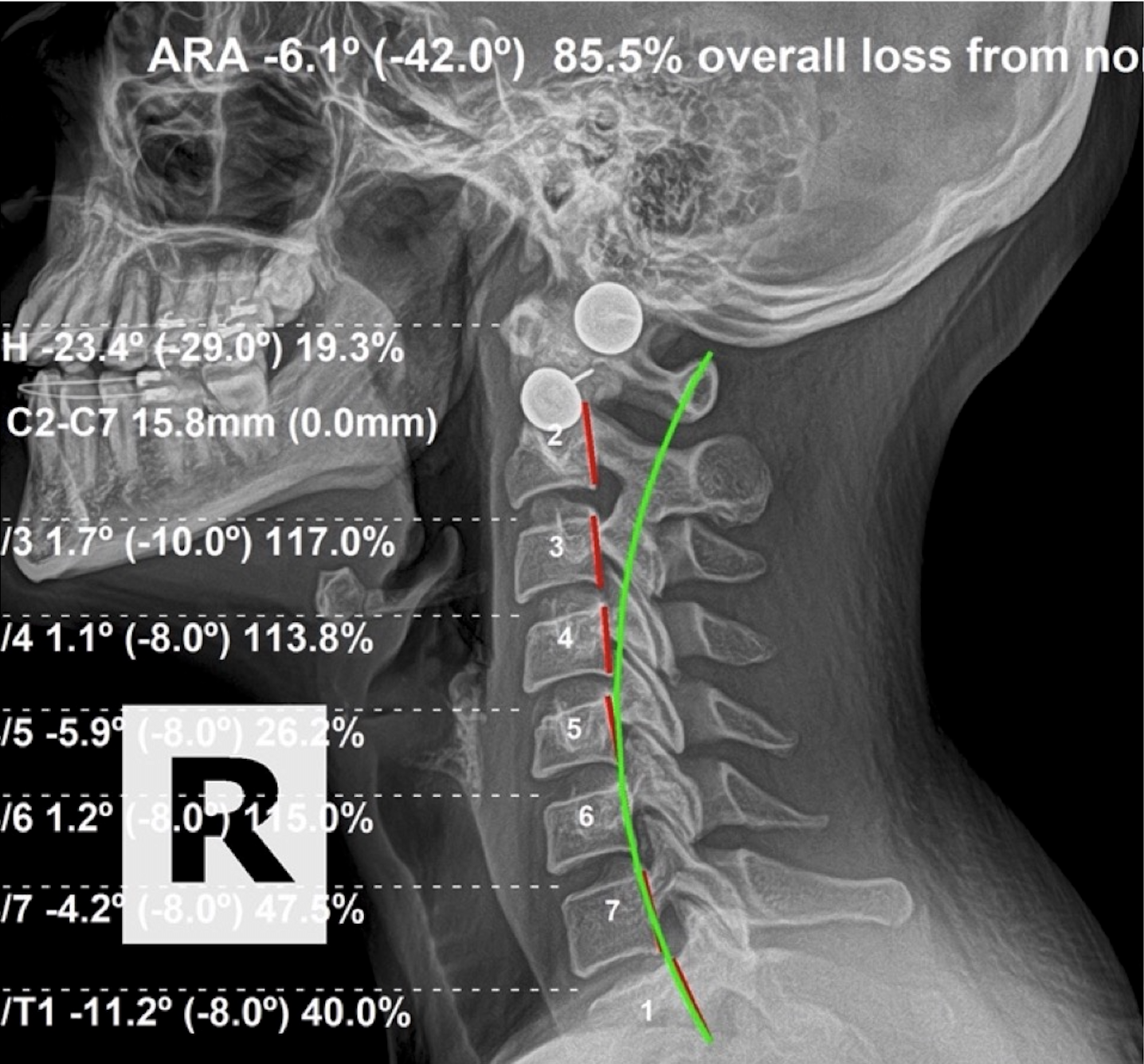Six-month re-evaluation lateral cervical X-ray showing ARA -6.1 degrees, 85.5 percent overall loss from normal, 17 percent improvement after corrective chiropractic care, Rochet Family Chiropractic Royal Palm Beach