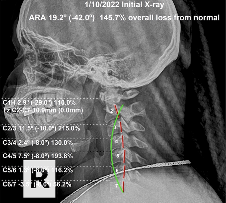 January 10, 2022 initial lateral cervical X-ray of a 26-year-old female showing a fully reversed neck curve (kyphosis) after an auto accident, Rochet Family Chiropractic Royal Palm Beach