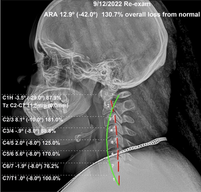 September 12, 2022 re-evaluation lateral cervical X-ray showing the neck curve improving toward normal after eight months of subluxation-based corrective care, Rochet Family Chiropractic Royal Palm Beach