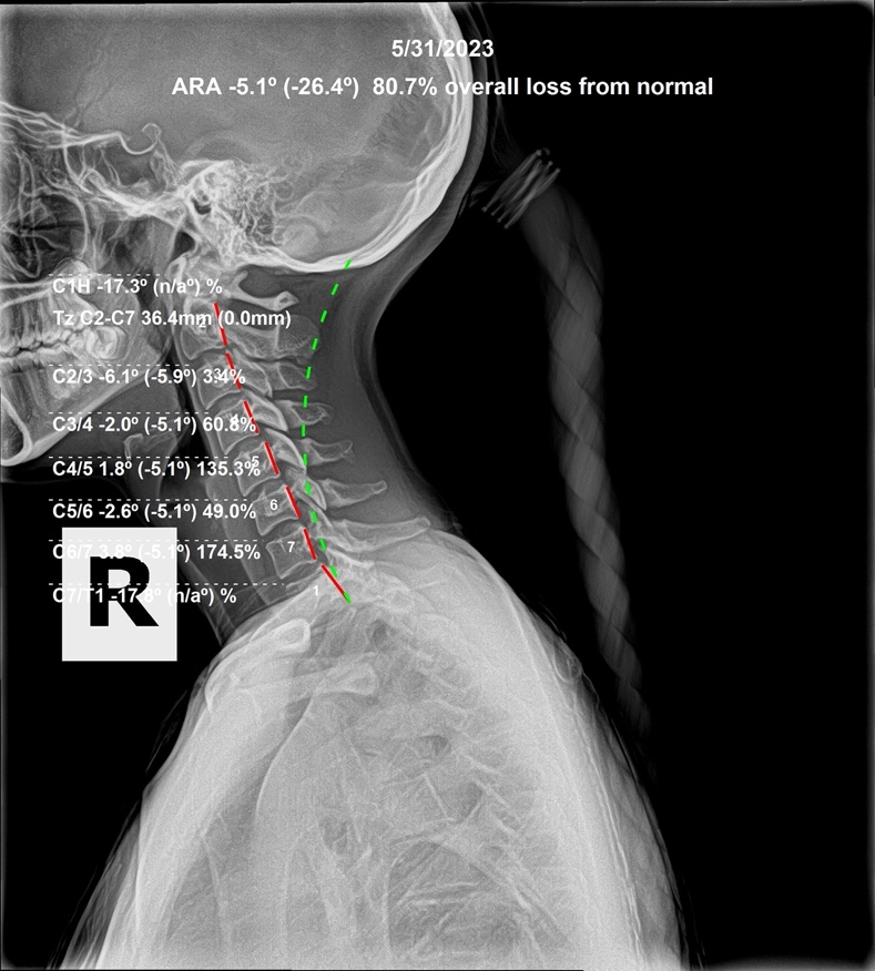 Initial AP lumbar X-ray showing an AI sacrum subluxation on the right and a lateral L3 L4 subluxation in a 16-year-old cross country runner, Rochet Family Chiropractic Royal Palm Beach