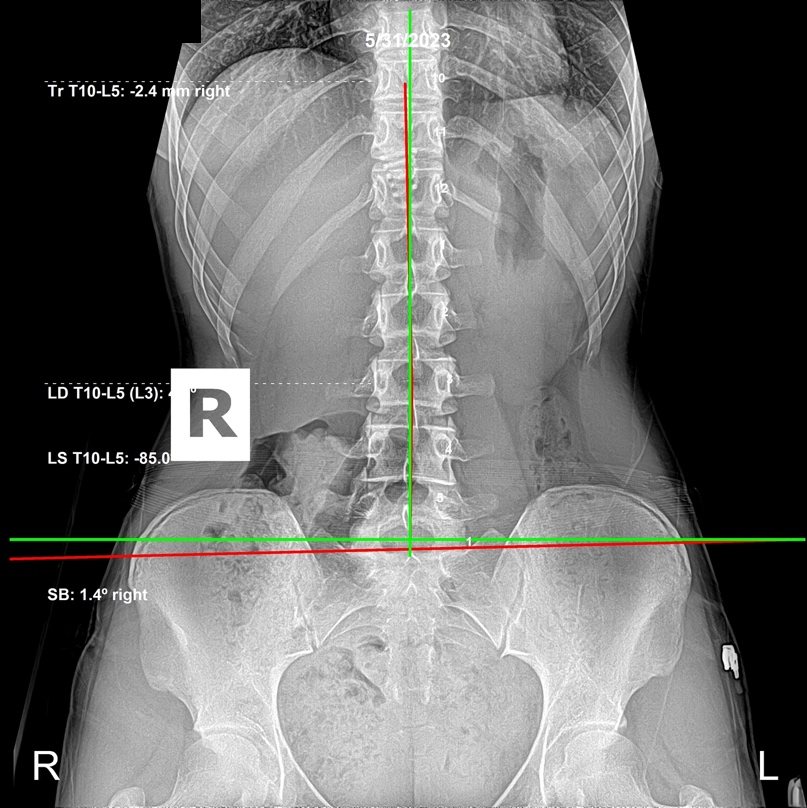 Initial lateral cervical X-ray showing a straightened neck and anterior head carriage from student neck in a 16-year-old, Rochet Family Chiropractic Royal Palm Beach