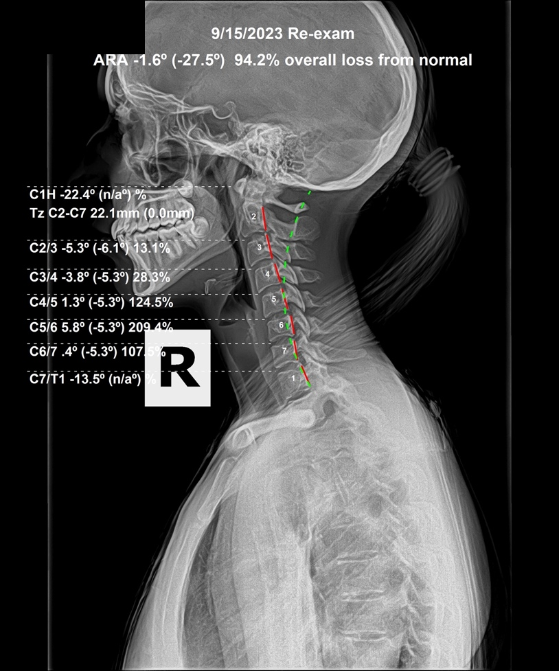 Re-evaluation AP lumbar X-ray showing the sacral subluxation reduced and mid-lumbar alignment straightened, Rochet Family Chiropractic Royal Palm Beach