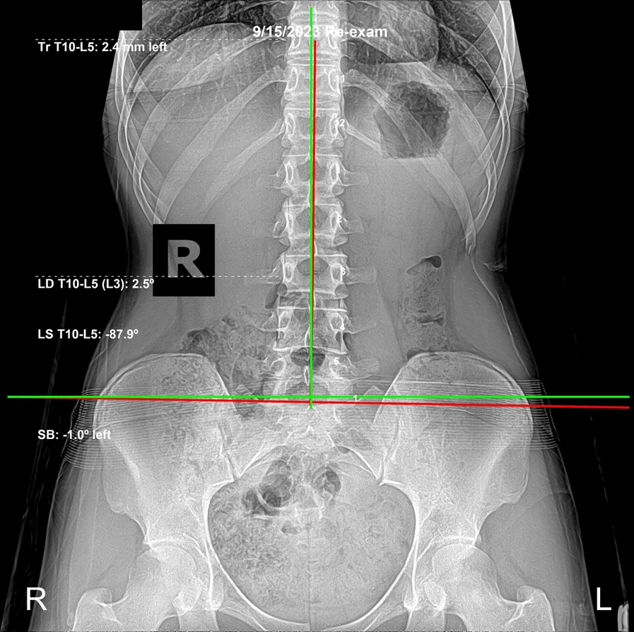 Re-evaluation lateral cervical X-ray showing a curve beginning to return and the head drawn back over the shoulders, Rochet Family Chiropractic Royal Palm Beach