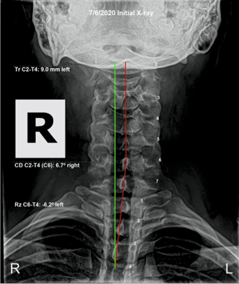 Initial AP cervical X-ray — Tr C2-T4: 5.0mm left, CD C2-T4 C8: 6.7 degrees right, Rz C6-T4: 4.3 degrees left — significant cervical subluxation before corrective care, Rochet Family Chiropractic Royal Palm Beach
