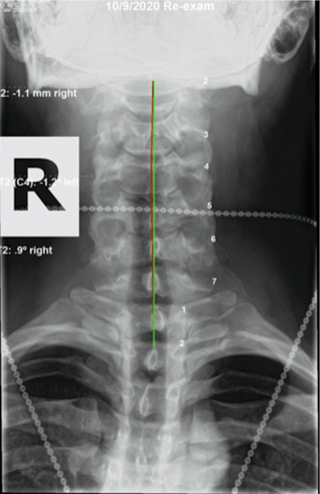 Re-evaluation AP cervical X-ray — C2: -1.1mm right, C2 Sp: 0.9 degrees right — near full correction of cervical subluxation, Rochet Family Chiropractic Royal Palm Beach