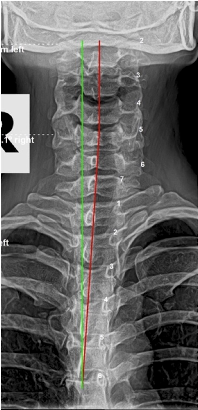 Initial lateral cervical X-ray showing significant cervical subluxation in 33-year-old asymptomatic female seeking proactive spinal evaluation, Rochet Family Chiropractic Royal Palm Beach