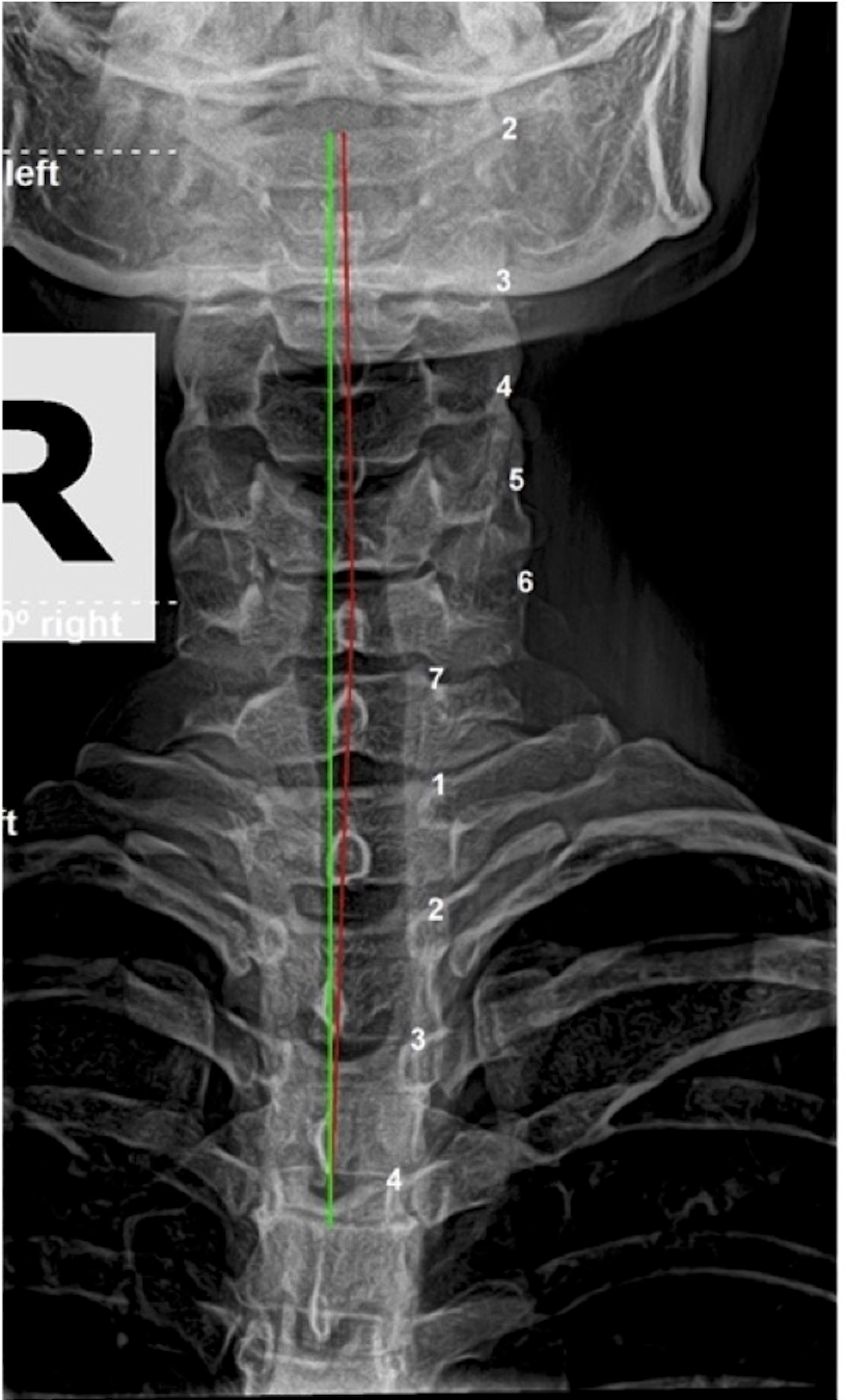 3-month interim re-evaluation lateral cervical X-ray showing significant cervical structural correction in proactive patient, Rochet Family Chiropractic Royal Palm Beach