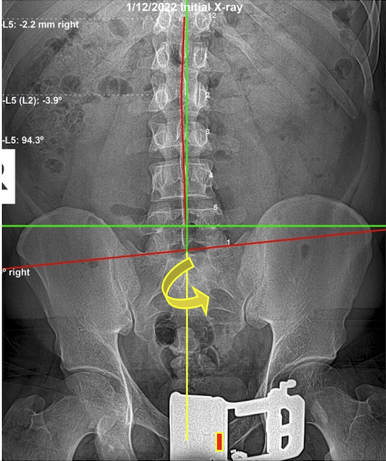 January 12, 2022 initial AP lumbar and pelvic X-ray of a 31-year-old male law enforcement officer showing an AI Sacrum with significant pelvic rotation, Rochet Family Chiropractic Royal Palm Beach