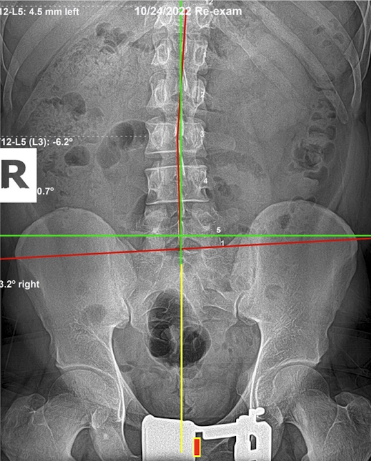 October 24, 2022 re-evaluation AP lumbar and pelvic X-ray showing dramatically improved pelvic alignment after nine months of subluxation-based corrective care, Rochet Family Chiropractic Royal Palm Beach