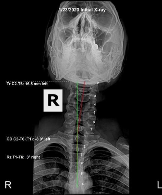 Initial AP spinal X-ray showing a severe lateral deviation without bony rotation in a 33-year-old male after a low back injury, Rochet Family Chiropractic Royal Palm Beach