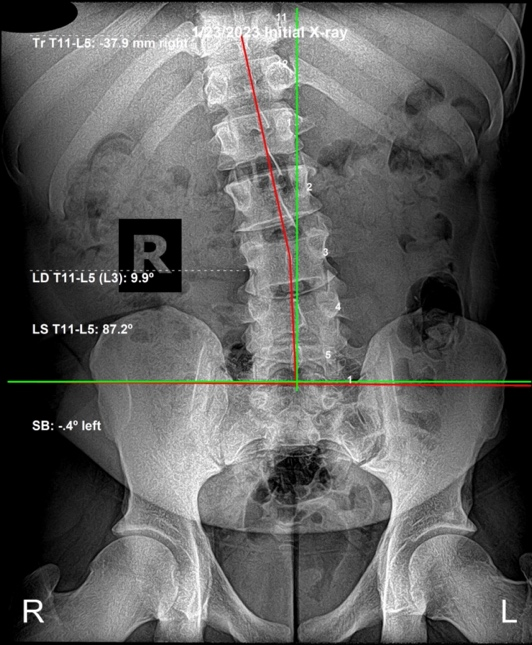 Initial lateral lumbar X-ray showing subluxation at L3 L4 disrupting normal spinal stability, Rochet Family Chiropractic Royal Palm Beach