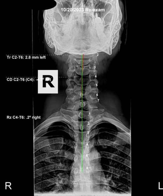 Re-evaluation AP spinal X-ray showing the lateral deviation substantially resolved after nine months of subluxation-based corrective care, Rochet Family Chiropractic Royal Palm Beach