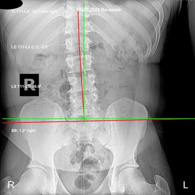 Re-evaluation lateral lumbar X-ray showing corrected L3 L4 alignment, Rochet Family Chiropractic Royal Palm Beach