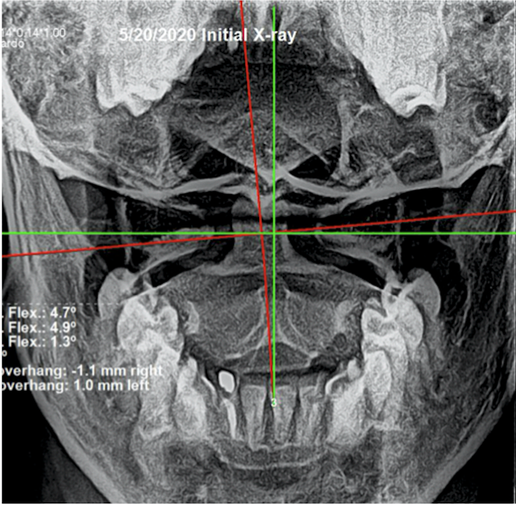 May 20, 2020 initial AP upper cervical X-ray — severe atlas subluxation, overhang -1.1mm right and 1.0mm left, flex measurements showing significant C1 misalignment, Rochet Family Chiropractic Royal Palm Beach