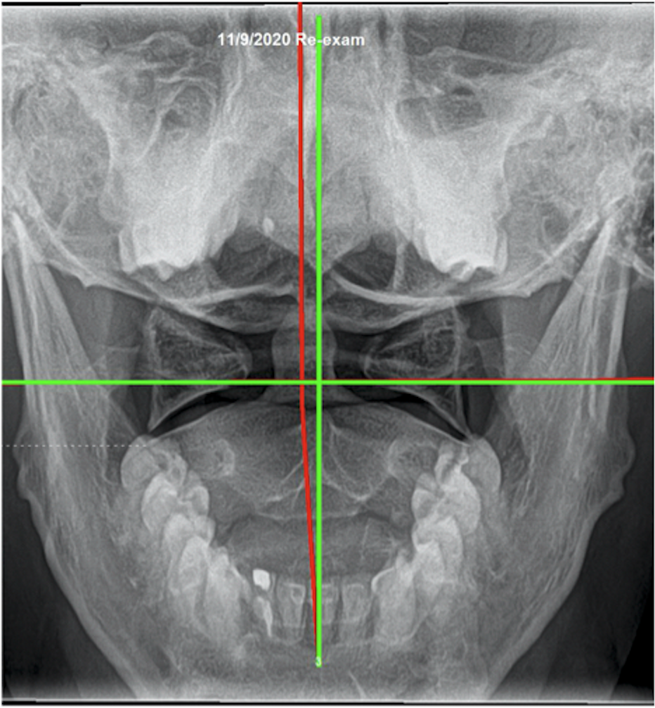 November 6, 2020 re-exam AP upper cervical X-ray — improved atlas position after 6 months of corrective care, Rochet Family Chiropractic Royal Palm Beach