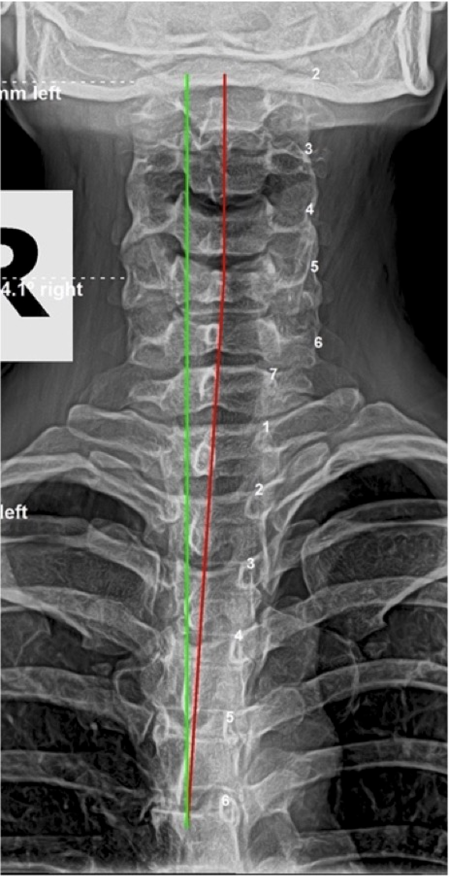Initial lateral cervical X-ray showing significant cervical subluxation in 33-year-old female who sought proactive chiropractic evaluation after friends shared their spinal correction results, Rochet Family Chiropractic Royal Palm Beach