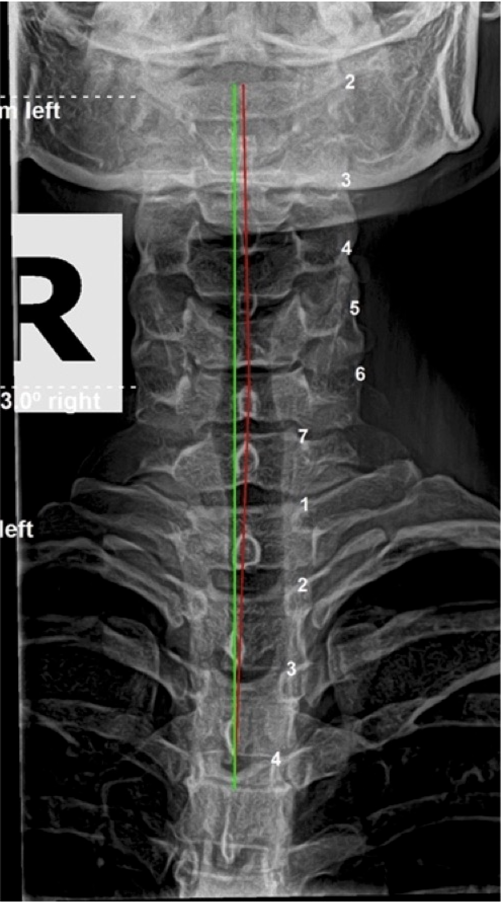 3-month interim re-evaluation lateral cervical X-ray showing significant cervical structural correction after corrective chiropractic care, Rochet Family Chiropractic Royal Palm Beach