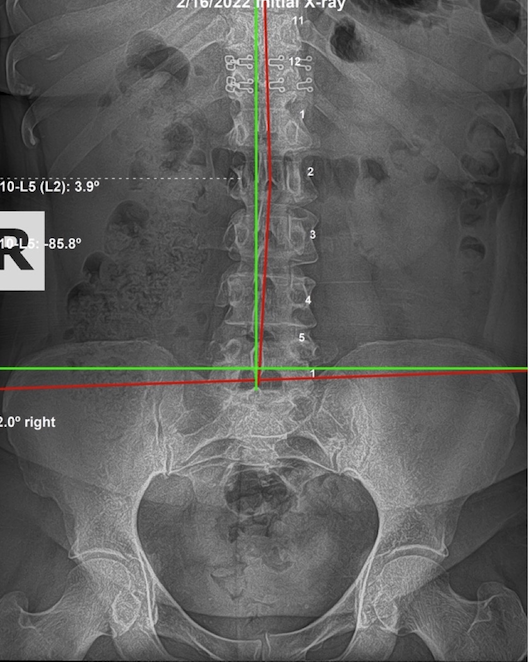 February 16, 2022 initial AP lumbar and pelvic X-ray of a 52-year-old female teacher showing an AI Sacrum with pelvic rotation to the left, Rochet Family Chiropractic Royal Palm Beach