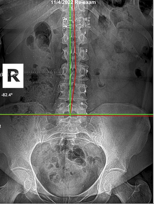 November 4, 2022 re-evaluation AP lumbar and pelvic X-ray showing dramatically improved pelvic alignment after nine months of subluxation-based corrective care, Rochet Family Chiropractic Royal Palm Beach