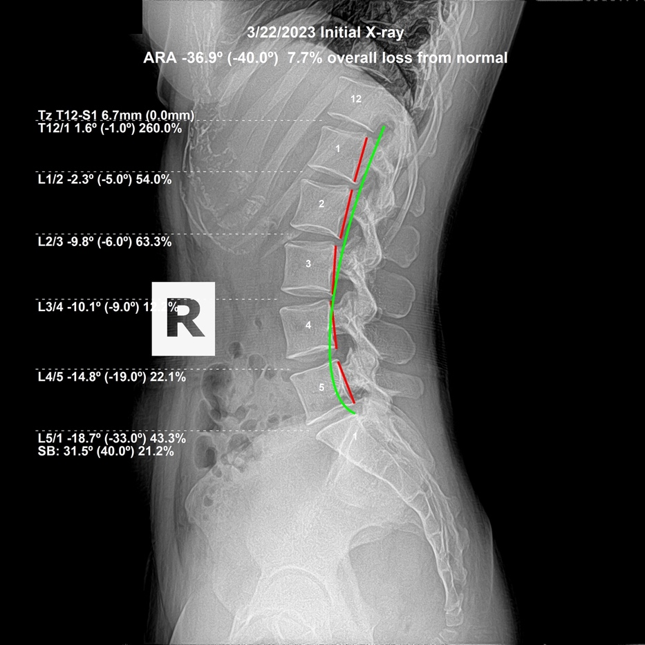 March 22, 2023 initial lateral cervical X-ray showing loss of the cervical curve from sustained neck flexion at work, Rochet Family Chiropractic Royal Palm Beach
