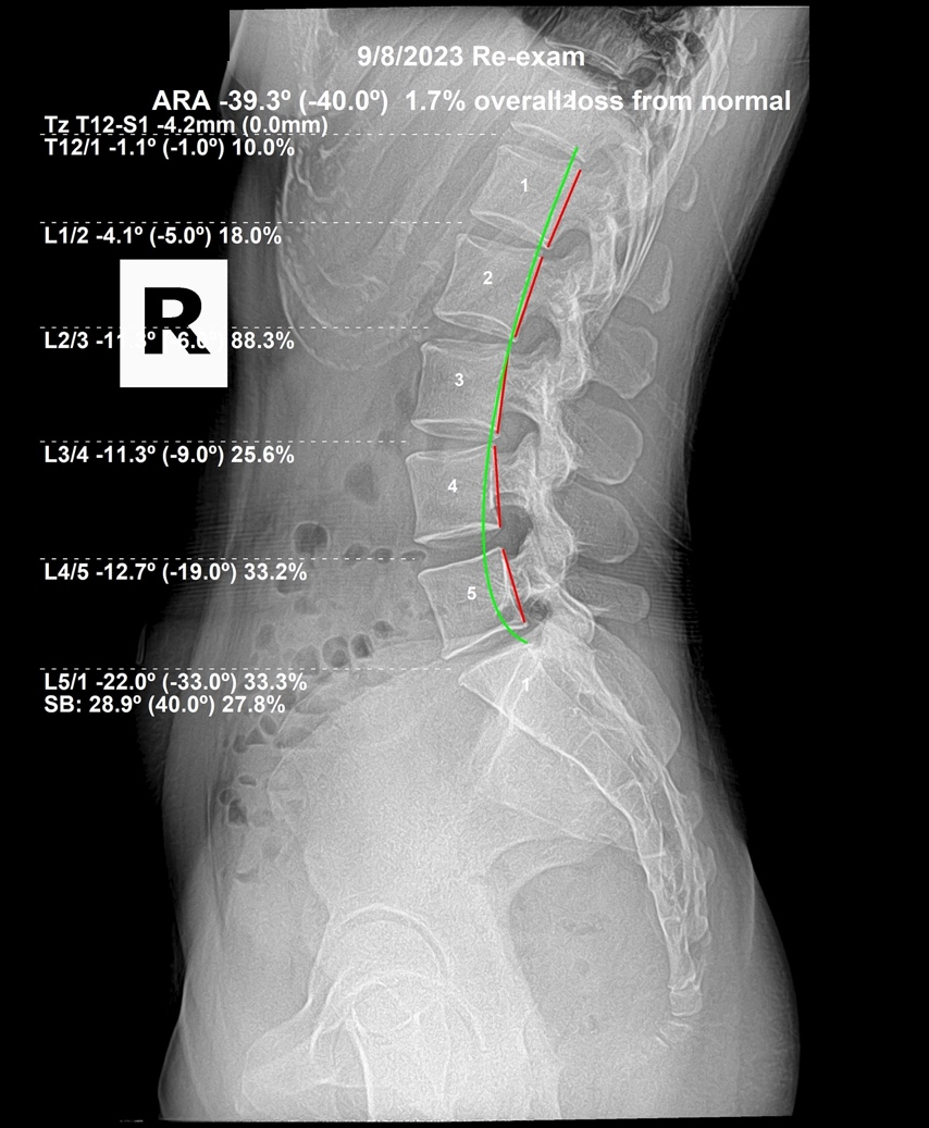 September 8, 2023 re-evaluation lateral cervical X-ray showing cervical correction after six months of care, Rochet Family Chiropractic Royal Palm Beach