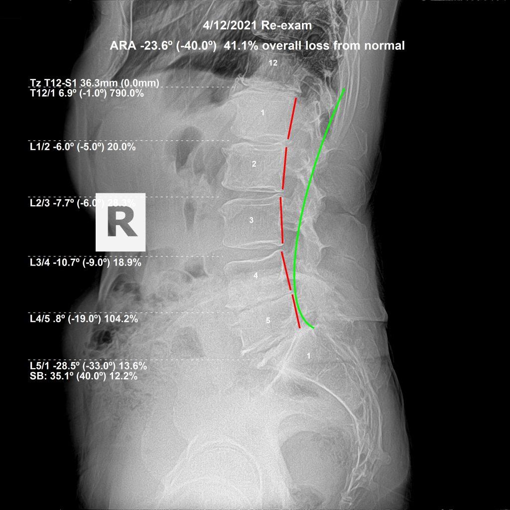 After chiropractic correction — lumbar alignment restored