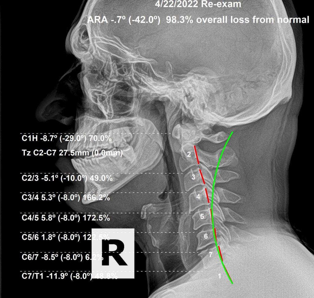 After 1 year without maintenance — spinal regression