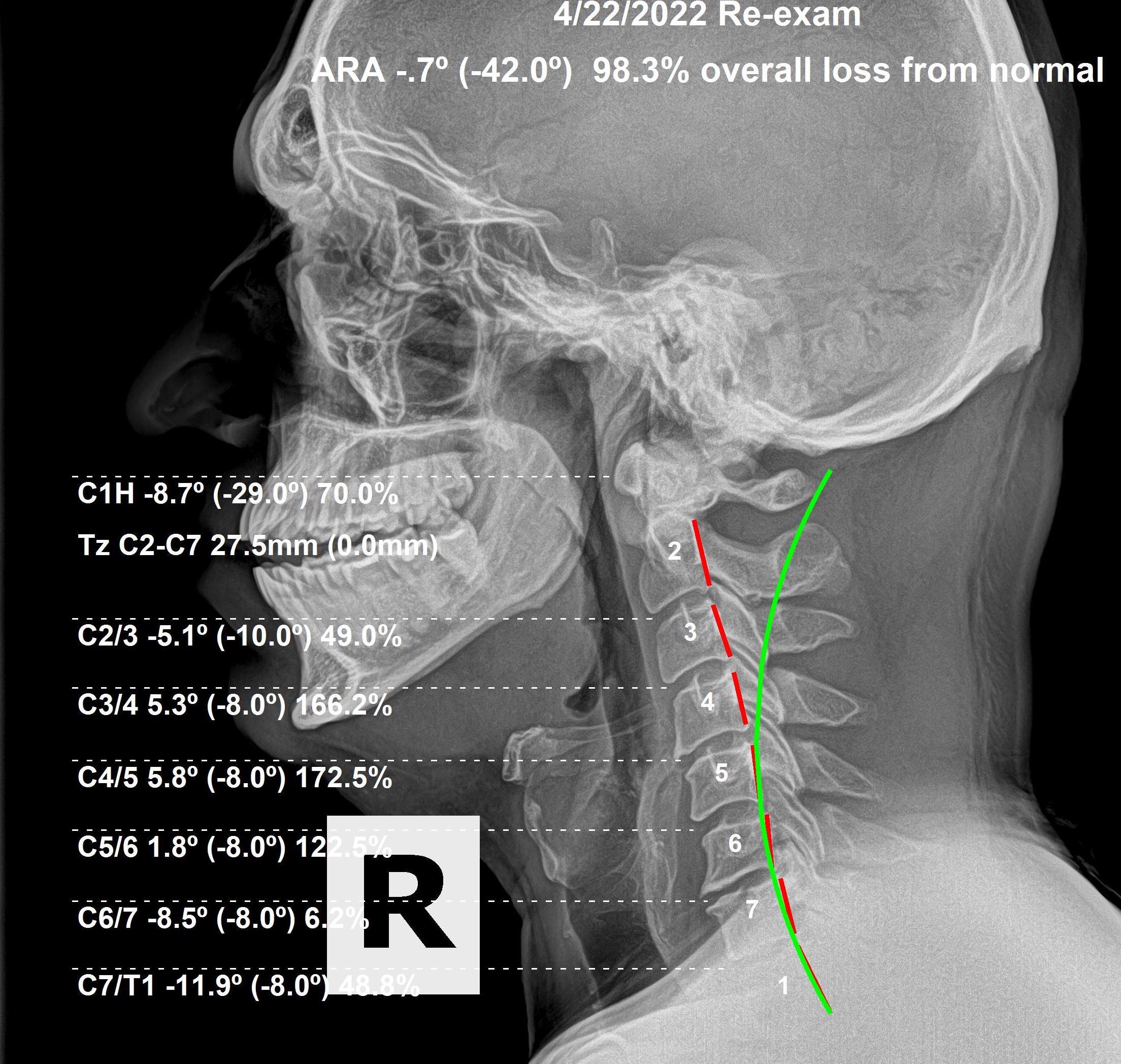 Spinal maintenance X-ray — lumbar correction Rochet Family Chiropractic Royal Palm Beach