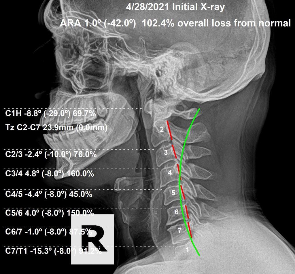 Initial spinal X-ray — lumbar subluxation before chiropractic care