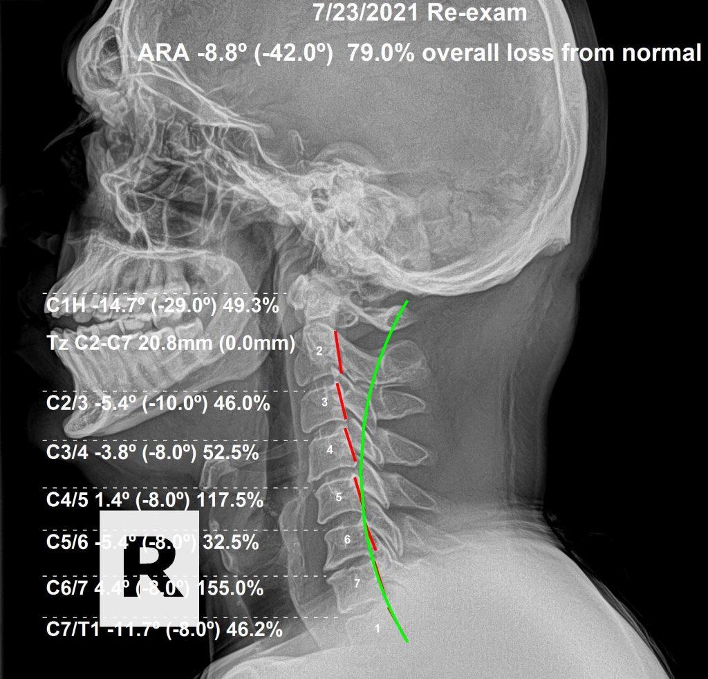 After 3 months chiropractic care — spinal alignment improvement