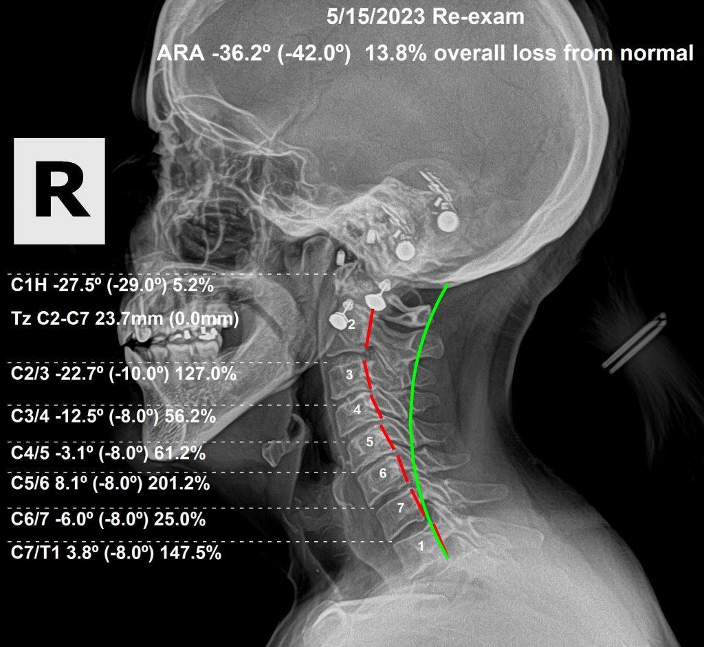 After subluxation correction — restored cervical curve, improved spinal alignment