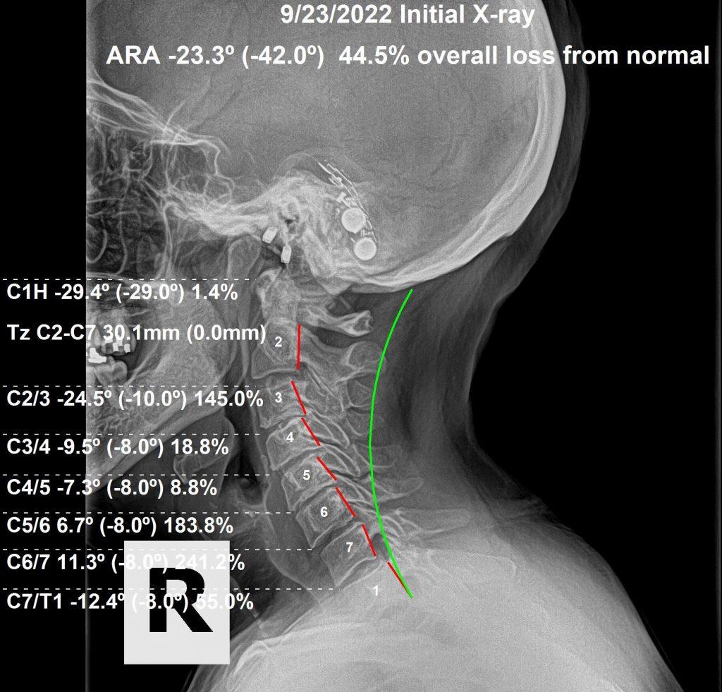 Before chiropractic care after auto accident — spinal alignment