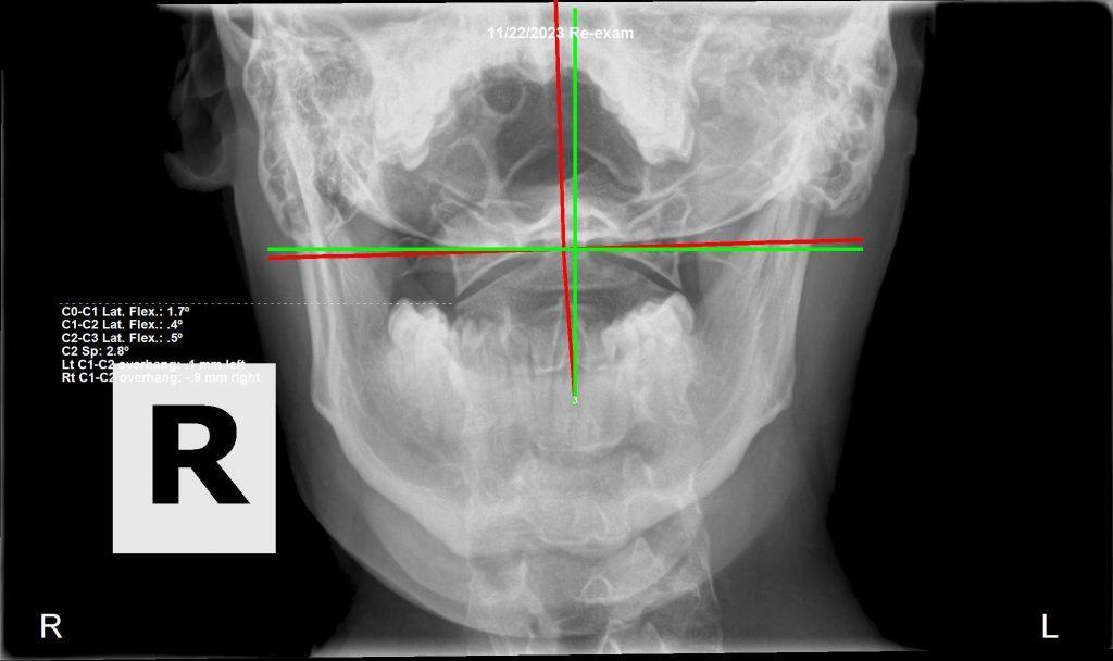 Follow-up cervical X-ray — spinal correction progress