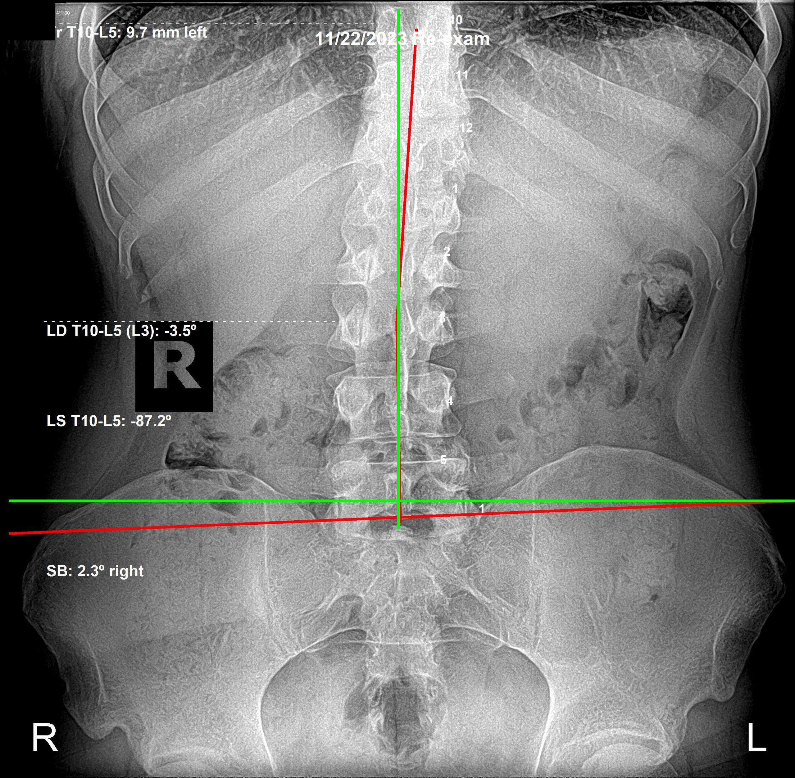 Spinal correction X-rays showing structural and functional progress — Rochet Family Chiropractic