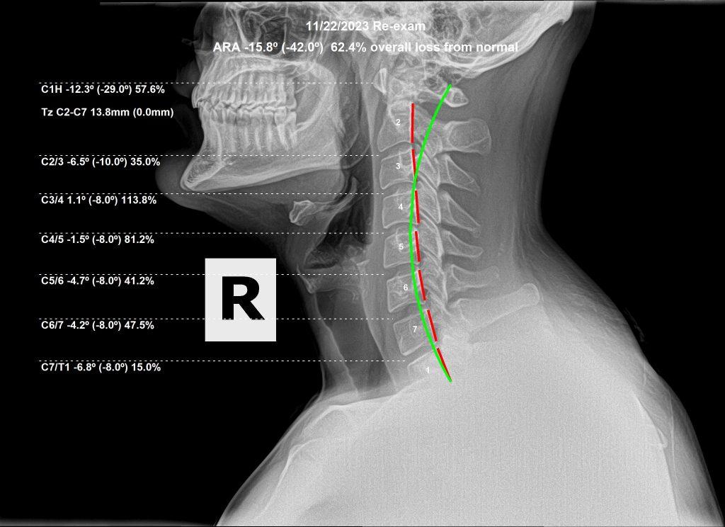 Lateral cervical X-ray after spinal correction